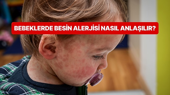 Bebeklerde Besin Kaynaklı Alerji Belirtileri Nelerdir? Hangi Besinler Alerji Yapar?