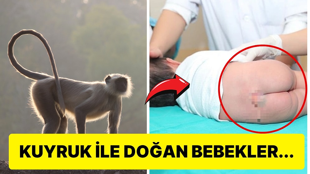 Neden Bazı İnsanlar Hayvanlar Gibi Kuyruklarla Doğar?