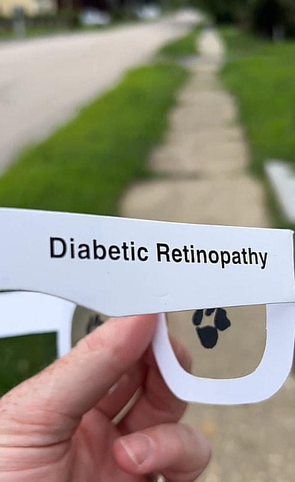 İlk gösterilen görme engeli Diyabetik retinopati.