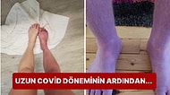 Covid Geçirdikten Sonra Nadir Bir Komplikasyon Sonucu Bacakları Mora Dönen Adam Tıp Dünyasını Şaşırttı!