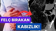 Kabızlık Şikayetiyle Hastaneye Giden Adamın Neredeyse Felç Kalmasına Yol Açan Rahatsızlığı