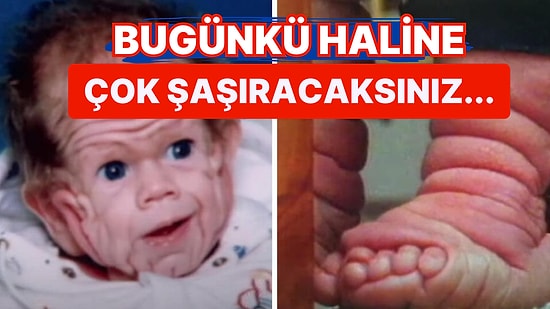 Henüz Bebekken 5 Yaşındaki Bir Çocuğun Derisiyle Doğan Adamın Filmleri Aratmayan Yaşam Öyküsü