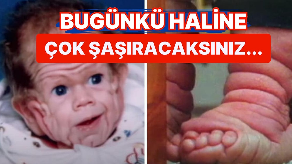 Henüz Bebekken 5 Yaşındaki Bir Çocuğun Derisiyle Doğan Adamın Filmleri Aratmayan Yaşam Öyküsü