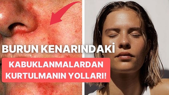 Halk Dilinde Egzama Olarak da Bilinen Seboreik Dermatit Nedir, Nasıl Tedavi Edilir?