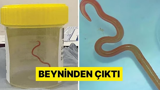 Geceleri Aşırı Terleyen 64 Yaşındaki Kadının Beyninden 8 Santimetre Uzunluğunda Canlı Solucan Çıkartıldı