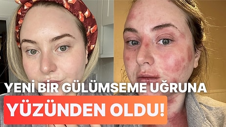 Yeni Bir Gülümseme İçin Diş Hekimine Giden Kadın, Tedavi Sonrasında Fil Derisi Hastalığına Yakalandı