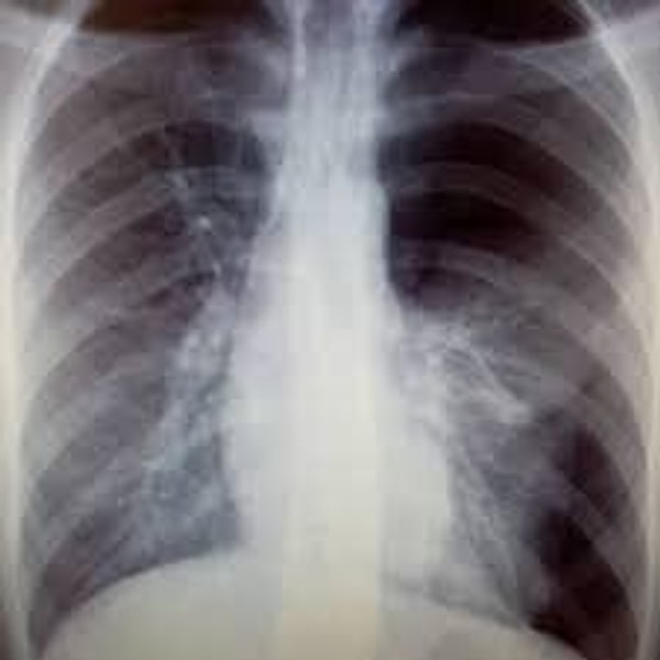 8. "Spontan pnömotoraks...Akciğerinizde bir delik ortaya çıkıyor. Bunu yaşadım."