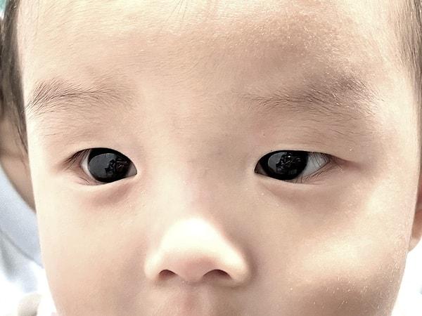 Yaklaşık beş gün sonra bebeğin gözlerindeki renk değişikliği azaldı ve bebeğin gözlerinin rengi tekrar kahverengi oldu.