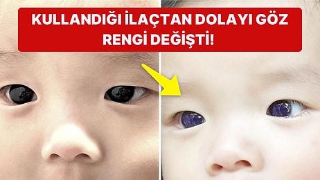 Kovid-19 Tedavisi Gören Altı Aylık Bebeğin Göz Rengi Kahverengiden Maviye Döndü