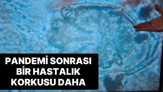 Uyuz Hastalığının Pandemi Sonrası Görülme Oranı Yüzde 50 Arttı