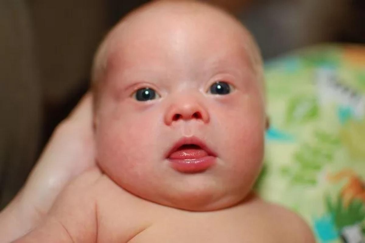 Роды дауна. Синдром дацна у новорожденны. Новорожденный ребенок Дауна. Младенцы с синдромом Дауна.