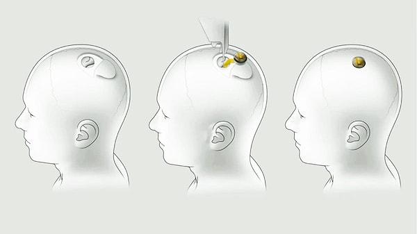 Katılımcılara sadece düşüncelerini kullanarak bir bilgisayarı kontrol etmelerini sağlamak amacıyla beynin bir bölgesine cihaz implant edeceklerini açıkladılar.
