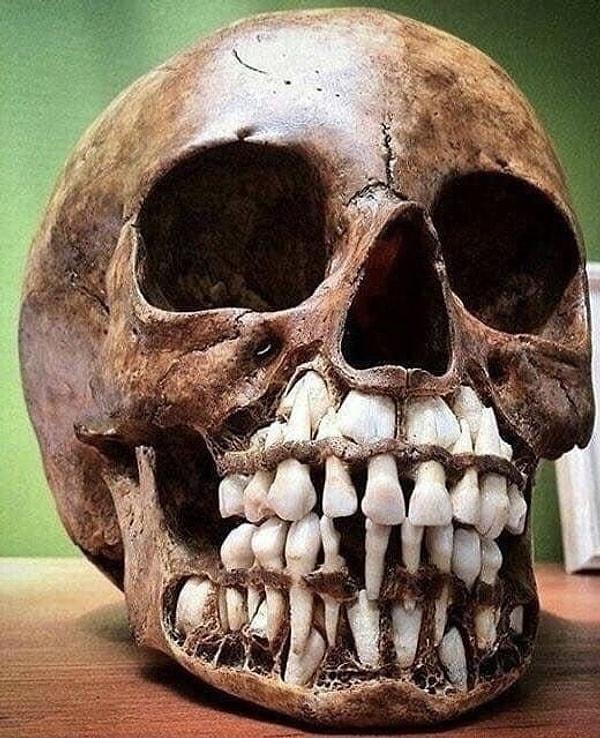 1. Hala bebeklik dişleri duran birisinin kafatası.