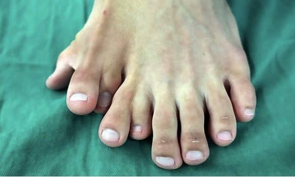 4. Normalden fazla parmaklara sahip bir ayak.