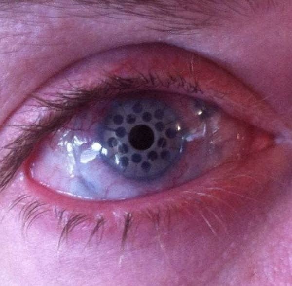 6. Hastalıklı bir korneayı yapay bir kornea ile değiştirmek için ameliyat olduktan sonra gözler böyle görünür.