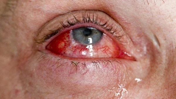 Kırmızı göz hastalığı hızla yayılıyor. Pakistan’da birçok eyalette görülen hastalık halka büyük korku yaşatıyor. Dawn gazetesindeki habere göre, Pakistan’ın çeşitli eyaletlerinde bulaşıcı “kırmızı göz” hastalığına yakalananların sayısı giderek artıyor.