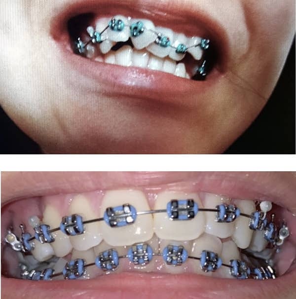 The appearance of a girl's braces when they were initially applied and just before their removal: