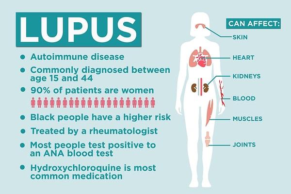 Peki Lupus hastalığı nedir, belirtileri nedir, neden oluşur, tedavisi nasıl olur?