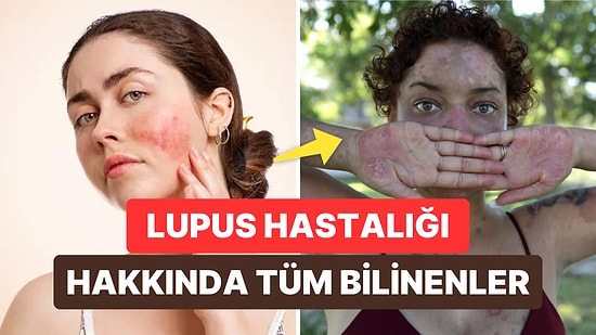 Lupus Hastalığı Nedir, Belirtileri Nelerdir? Bağışıklık Sistemini Etkileyen Lupus Hastalığı Ölümcül müdür?