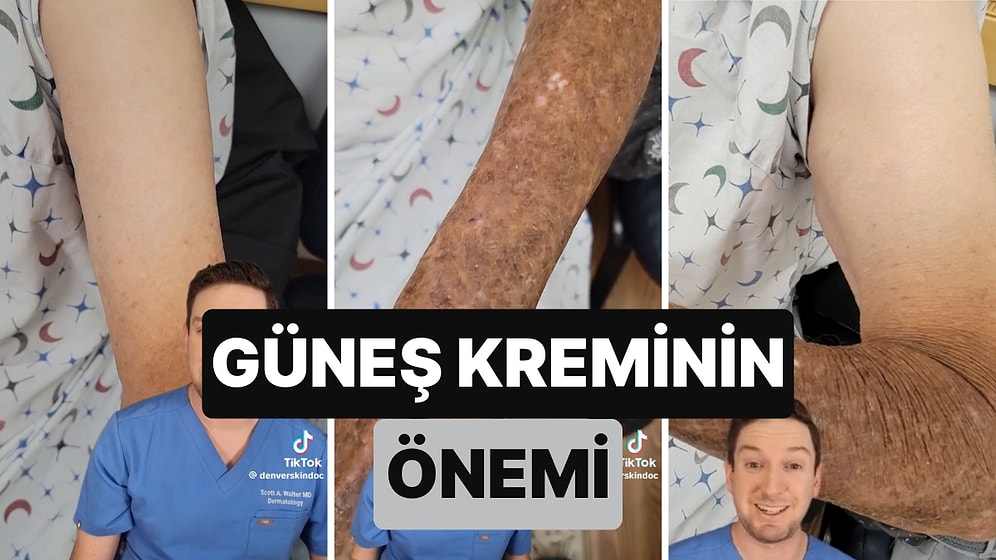 Bir Dermatolog Güneş Kreminin Önemini Bir Hastasının Kolunun Görüntüsü ile Net Bir Şekilde Ortaya Koydu