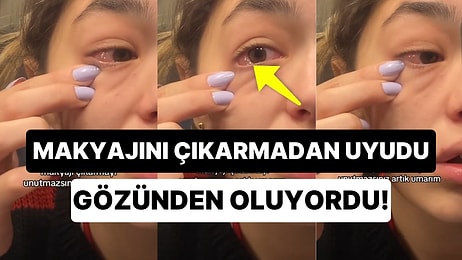 Makyajını Çıkartmadan Uyuyanlar Dikkat: Makyajlı Uyuyan Kadın Az Kalsın Gözünden Oluyordu!