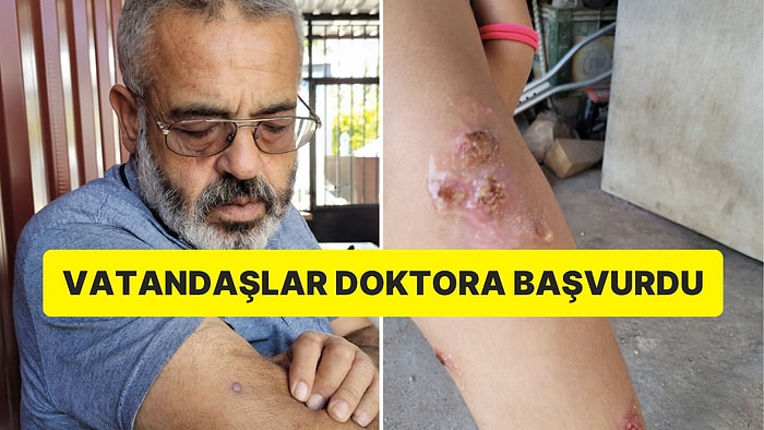 Hatay’da Depremzedelerin Yara Problemi: Vücutlarında Çıkan Yaralar Yüzünden Birçok Kişi Doktora Başvurdu