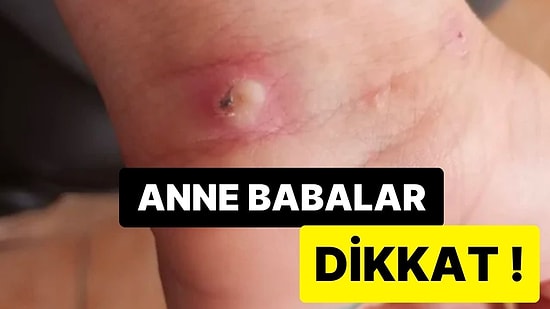 Öğretmenler Birliği Sendikası’ndan ‘Uyuz’ Uyarısı: Öğrenciler Arasında Hızla Yayılıyor