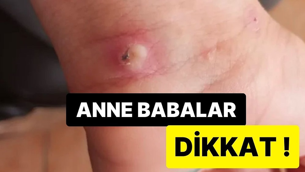 Öğretmenler Birliği Sendikası’ndan ‘Uyuz’ Uyarısı: Öğrenciler Arasında Hızla Yayılıyor