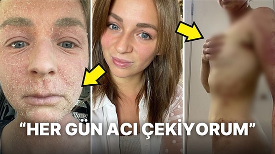 Korkunç Bir Cilt Hastalığıyla Pençeleşen Kadının Yürek Burkan Açıklamaları: "Her Gün Çığlık Atıyordum..."