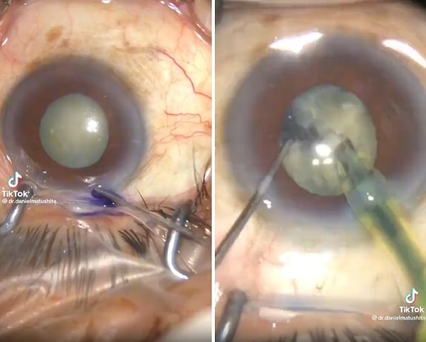 Sosyal medyada paylaşılan ve gündem olan bir videoda da, bir doktor hastasına katarakt ameliyatı yaparken görülüyor.