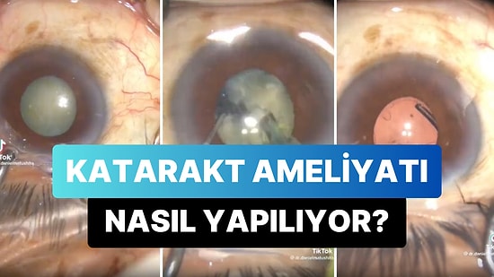 Katarakt Ameliyatının Nasıl Yapıldığını Görünce Doktorlara Bir Kez Daha Teşekkür Edeceksiniz!