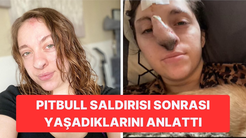 Pitbull Saldırısından Sonra Burnunda Kıllar Çıkmaya Başlayan Kız İnternet Zorbalarına Boyun Eğmedi