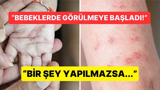 Ülkemizde Artan Uyuz Vakaları Hakkında Doktor ve Vatandaşların "Artık Önlem Alınmalı" İsyanı Gündemde