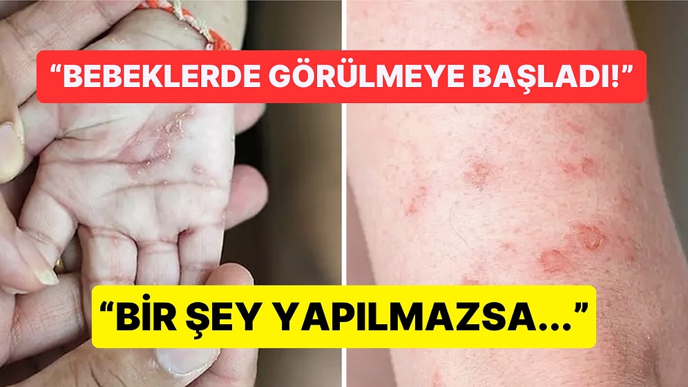 Ülkemizde Artan Uyuz Vakaları Hakkında Doktor ve Vatandaşların "Artık Önlem Alınmalı" İsyanı Gündemde