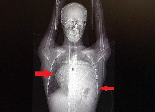 Normalde kalbin özellikle alt ucunun göğüs boşluğunda, iman tahtası orta çizgi kabul edilirse, sola bakar şekilde durduğuna dikkat çeken Prof. Dr. Taşçı, sözlerini şöyle sürdürdü: