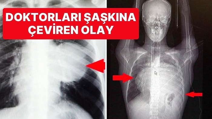 Kalbi Yer Değiştirdi! Doktorlar Bile Şaşkına Döndü