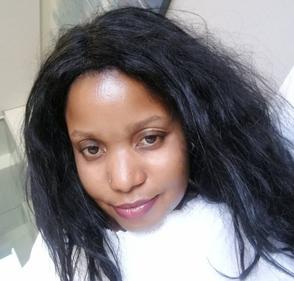 Lazer Epilasyon Yaptırdıktan Sonra Yüzünde Büyük Yanıklar Oluşan