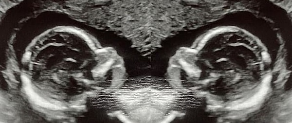 İlk ultrason sırasında her iki rahminde de birer bebek taşıdığını öğrenince şaşkına döndü.
