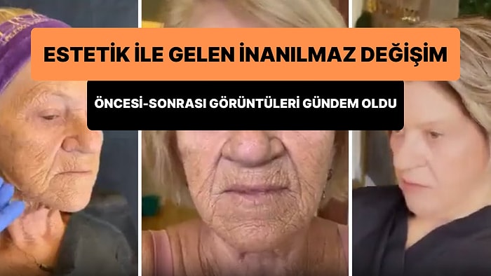 Yüzünde Sarkma ve Kırışıklıklar Olan Yaşlı Kadının Estetik Sonrasında Yaşadığı İnanılmaz Değişim