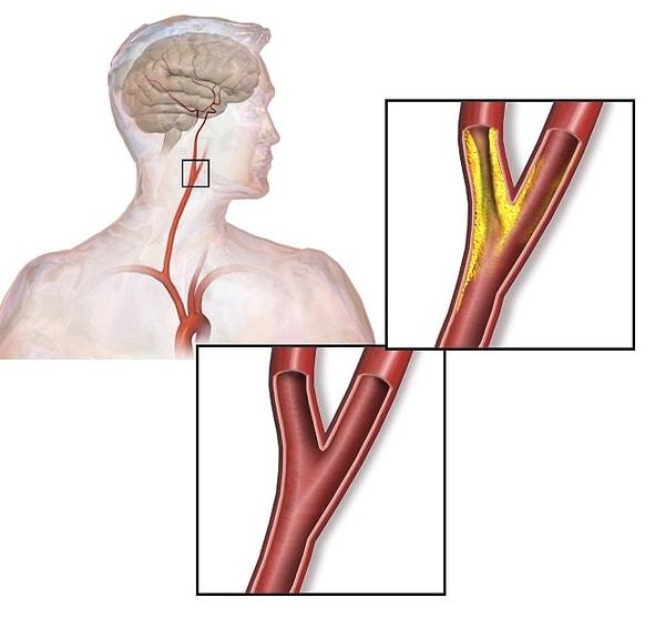 Şah damarı boynumuzun her iki tarafında bulunan ve beyne kan akışı sağlayan ana atar damarlardır. Şah damarlarının iç yüzesi normalde pürüzsüzdür.