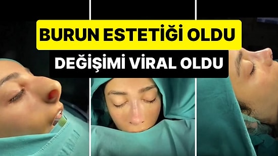 Ezel, Polat Alemdar Değişimi İşine Baksın: Burun Estetiği Olan Kişinin Viral Olan Değişimi