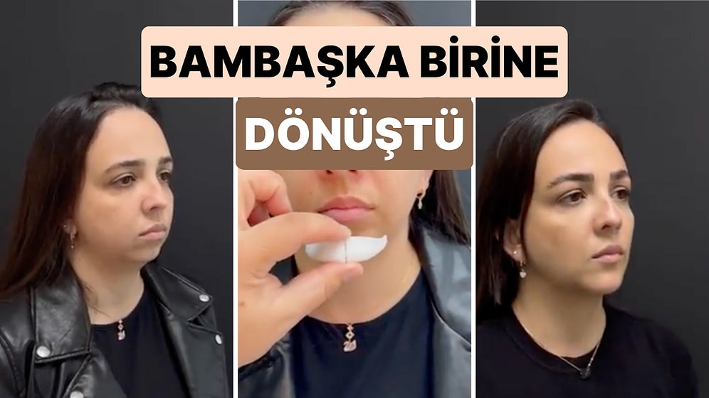 Son Dönemde En Sık Yaptırılan Estetik Operasyonlardan Biri Olan Çene Estetiği ile Bambaşka Birine Dönüştü