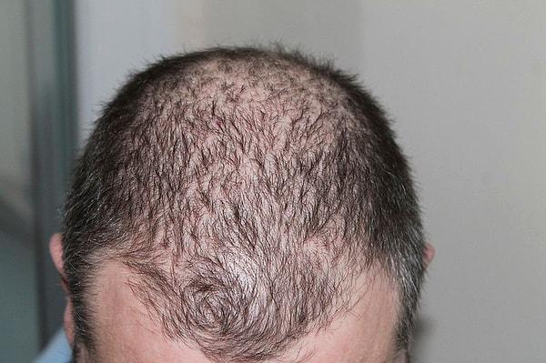 İngiliz Dermatologlar Birliği'ne göre, dökülen saç telleri otomatik olarak yeniden çıkar ve böylece "başımızdaki toplam saç teli sayısı sabit kalır". Ancak bazen saç dökülmesi daha ciddi faktörlerden kaynaklanabilir. Ve bazı durumlarda kalıcı olabilir.