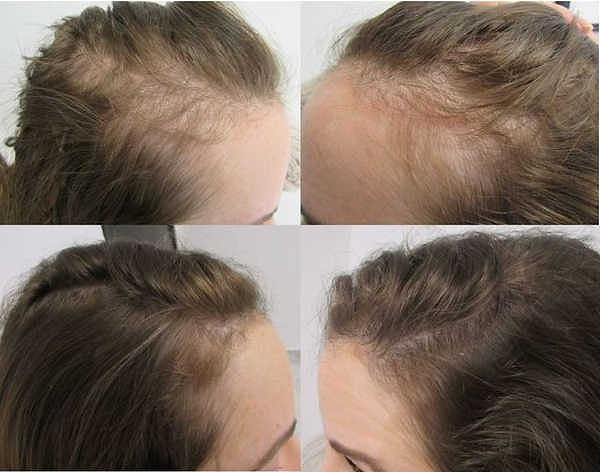 İngiliz Dermatologlar Derneği'ne göre, bu durum normal saç büyüme döngünüzde bir bozulmaya neden olarak daha fazla folikülün telojen evre olarak da bilinen dökülme evresine geçmesine neden olur.