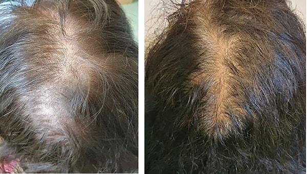 "Normalde kafa derisindeki saçların yalnızca yüzde 10'u telojen fazdadır, ancak telojen effluviumda bu oran yüzde 30 veya daha fazlasına çıkar."