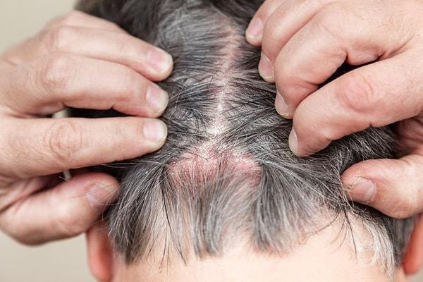 Genellikle hafiftir ve birkaç gün içinde geçebilir, ancak bazı ciddi folikülit enfeksiyonları kalıcı saç kaybına neden olabilir ve saçların tekrar çıkmadığı kel bölgeler bırakabilir.