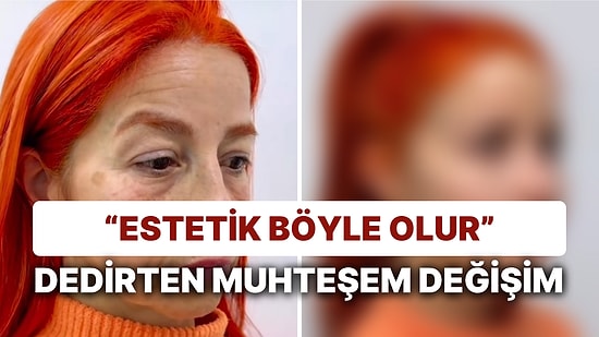 Estetikle 20 Yaştan Fazla Gençleşen Kadının Görüntülerine Yapılan Yorumlar "Ajda Pekkan Görmesin" Dedirtti