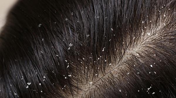 Saçlarda kepek oluşmasının nedeni saç diplerinin aşırı keratin üretmesinden kaynaklanmakta.