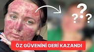 Akne Problemi Yüzünden Zorbaların Yorumlar Yağdırdığı Genç Kadın Güzellik Influencerı Oldu