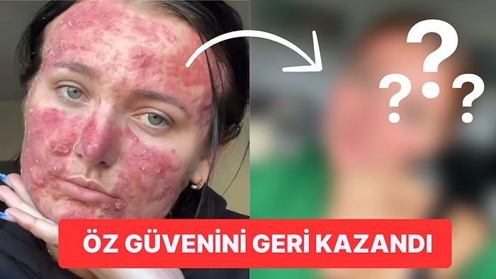 Akne Problemi Yüzünden Zorbaların Yorumlar Yağdırdığı Genç Kadın Güzellik Influencerı Oldu